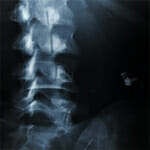 medical malpractice neck injury